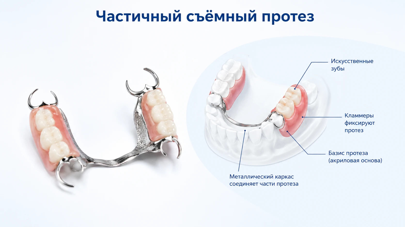 Аккуратная схема частичного съёмного протеза для замещения отсутствующих зубов