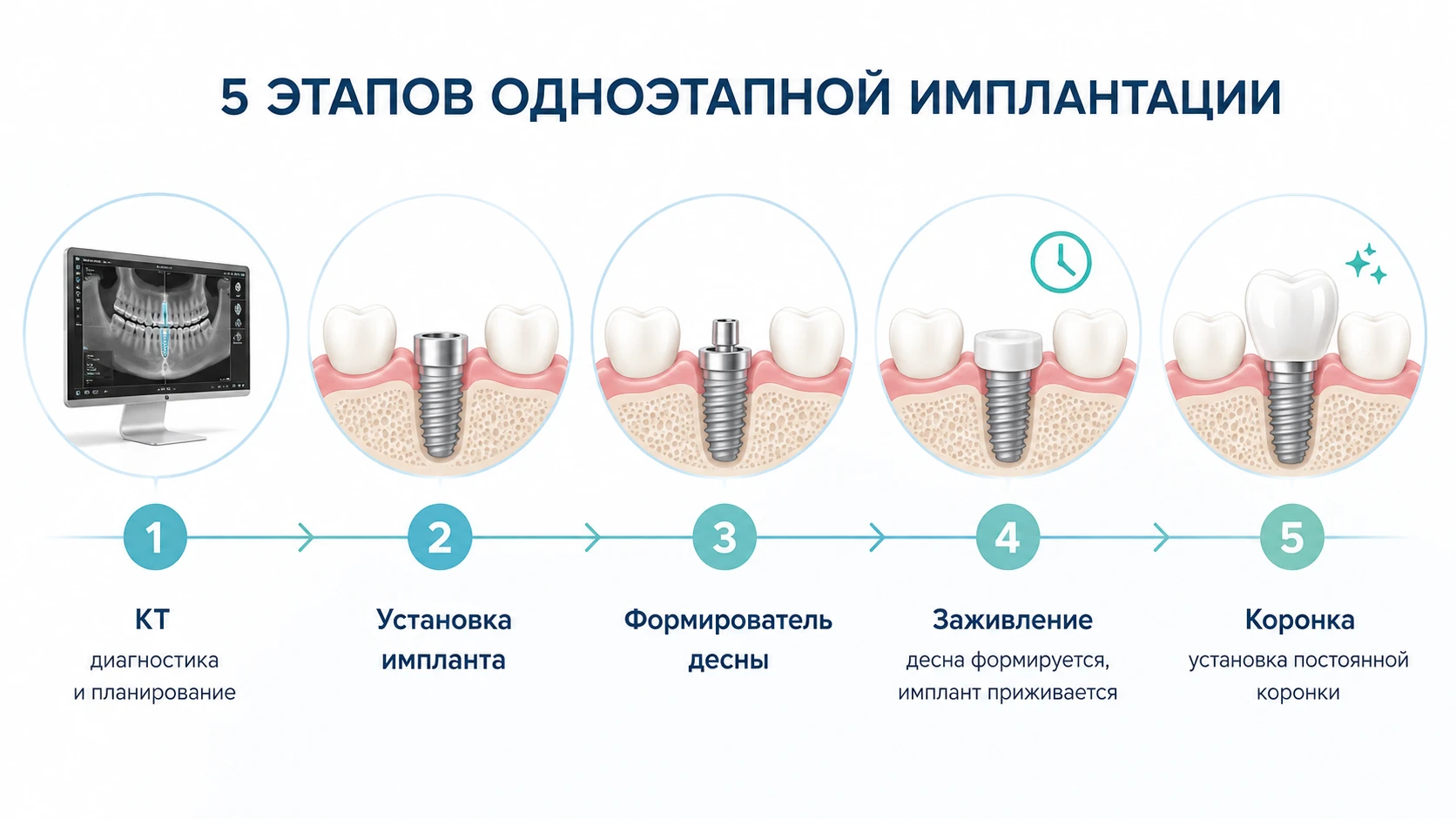 Пошаговая схема одноэтапной имплантации: КТ, установка импланта, формирователь, заживление и коронка