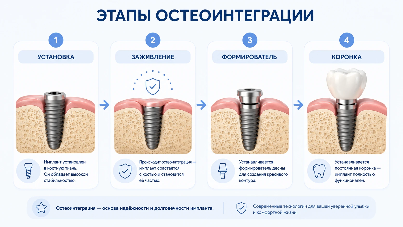 Схема этапов остеоинтеграции: установка импланта, заживление, формирователь и коронка