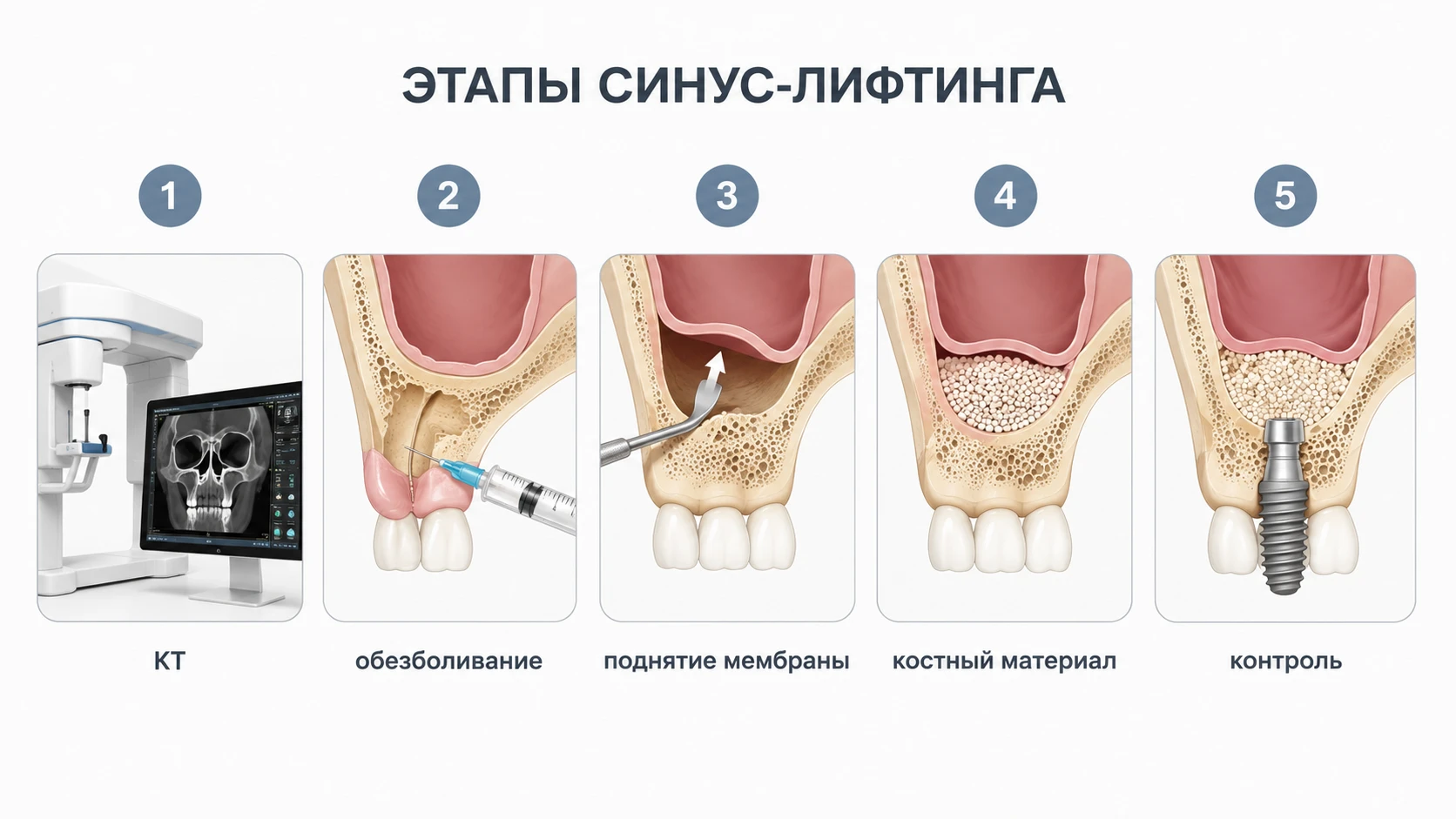 Этапы синус-лифтинга: КТ, обезболивание, поднятие мембраны, костный материал и контроль