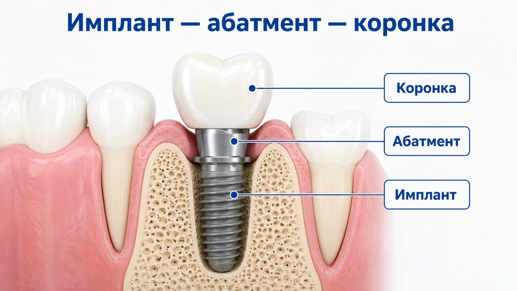 Схема имплантационной системы: имплант в кости, абатмент и коронка