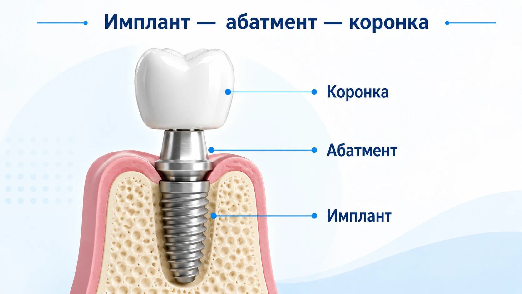 Схема строения зубного импланта: имплант, абатмент и коронка