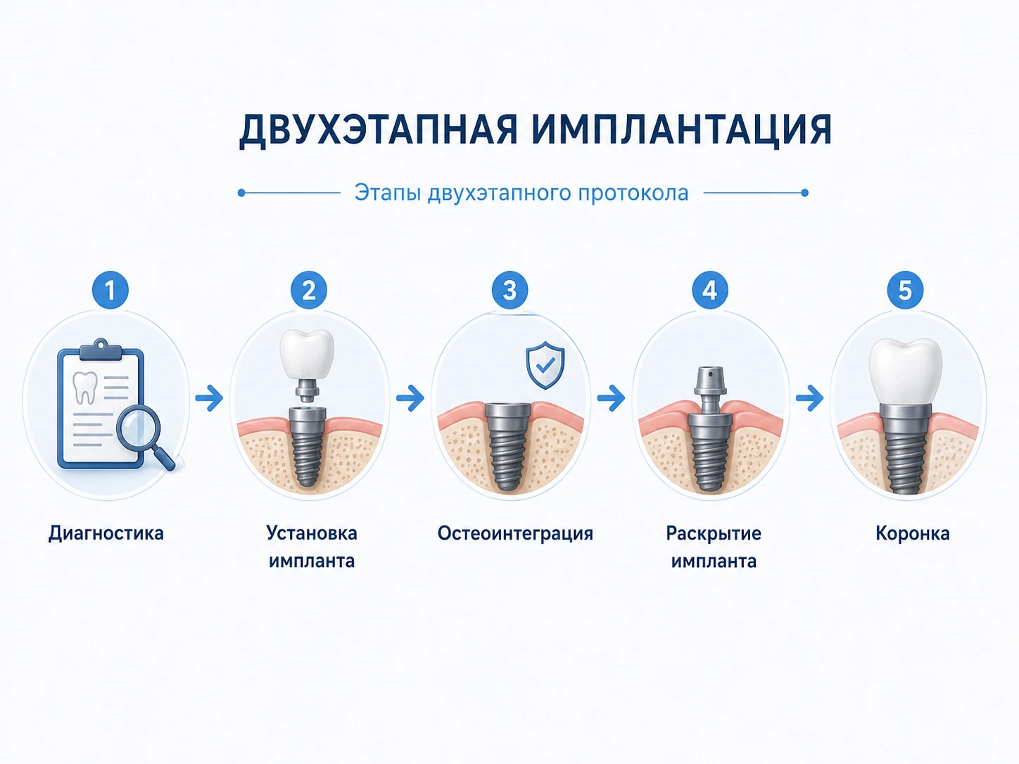 Инфографика timeline: диагностика, установка импланта, остеоинтеграция, раскрытие и коронка