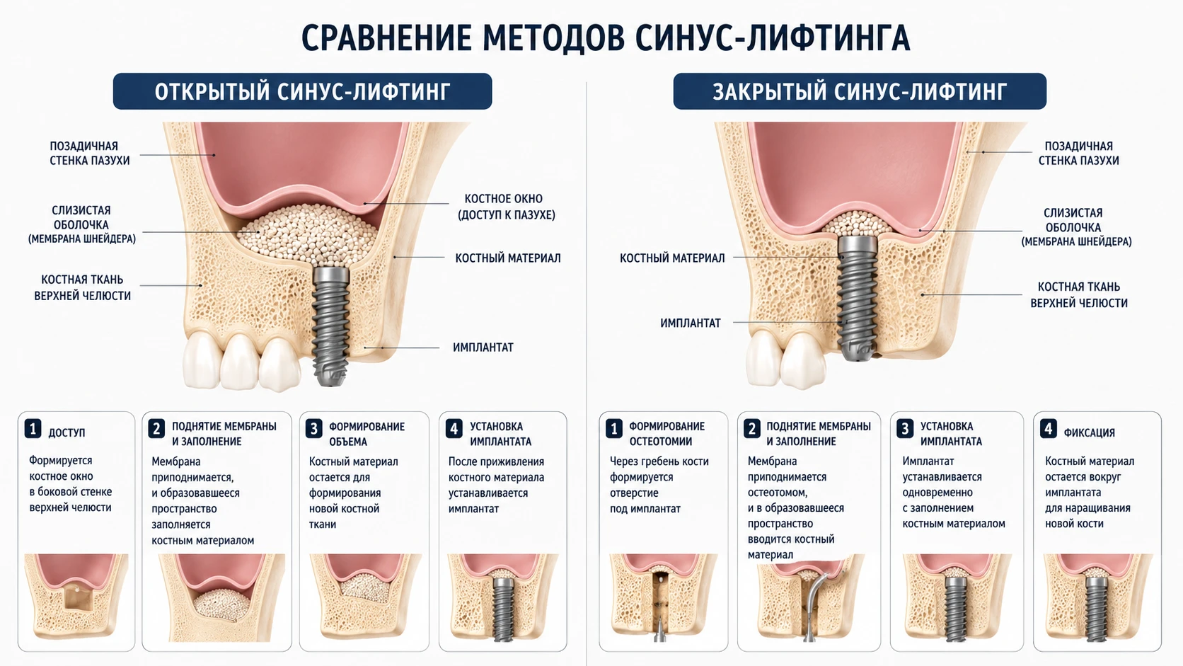 Открытый и закрытый синус-лифтинг: спокойная сравнительная схема
